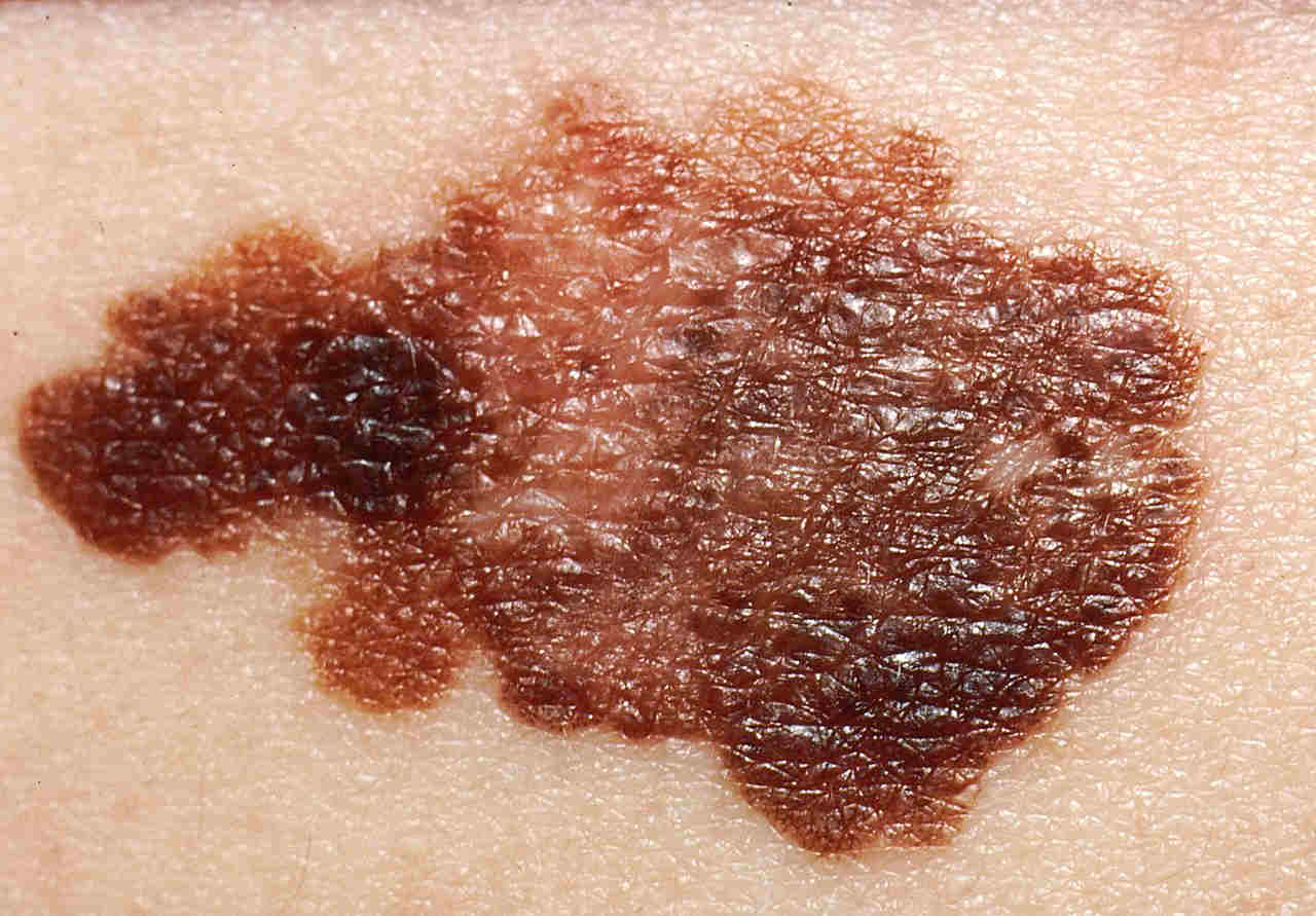 melanoma.jpg