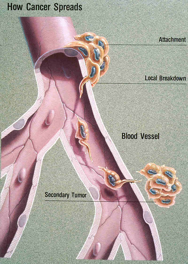 metastasis.jpg