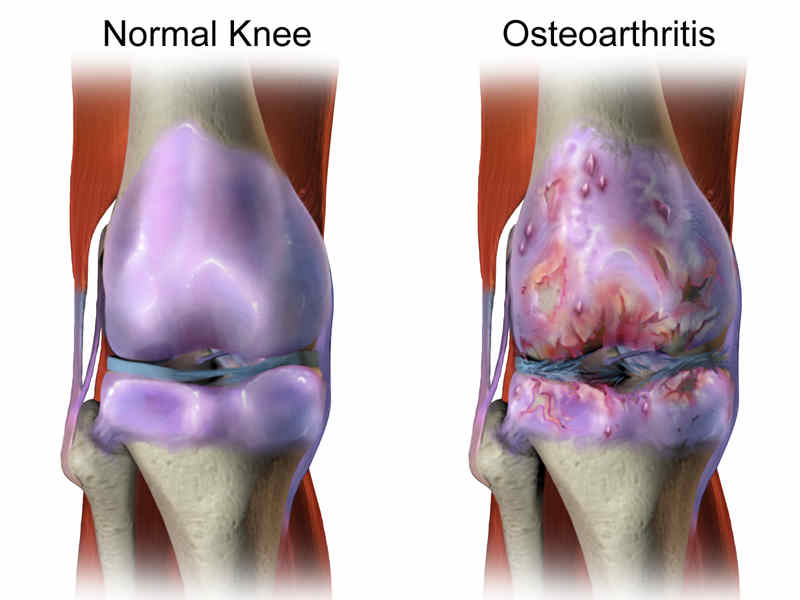 osteoarthritis.jpg