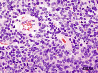 cerebellarMedulloblastoma.jpg