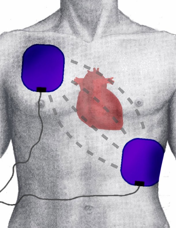 defibrillation.jpg