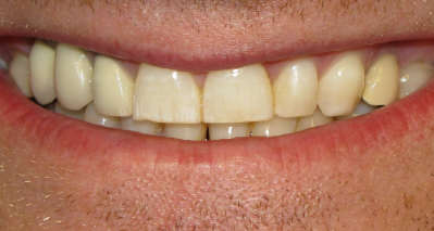 fluoridation.jpg